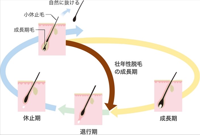 男性の薄毛について