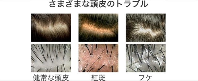 頭皮のトラブルは何故起きる？